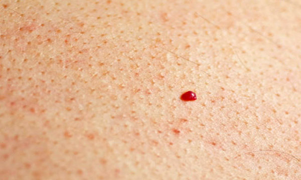 Nei rossi sulla pelle o angiomi rubino, cosa sono e quando diventano pericolosi